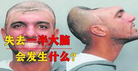 少了一半大脑会发生什么后果?