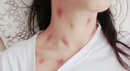 为什么女生的脖子上经常会有红印?