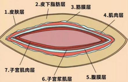 为啥剖腹产要用手撕成大口,而不是用刀切开?
