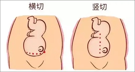 为啥剖腹产要用手撕成大口,而不是用刀切开?