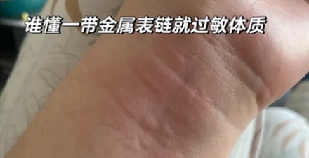 为什么金属过敏的人,只对金子不过敏?