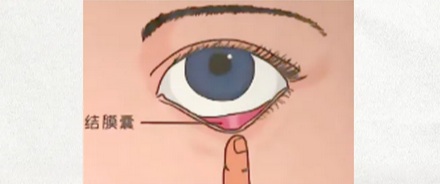为什么有的人揉眼睛时，眼睛会发出咯吱咯吱的响声？