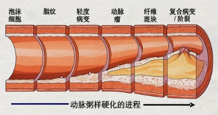 为什么心梗大都发生在清晨？