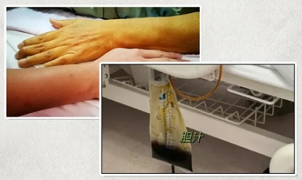 为什么胆囊切除后,医生要让你喝自己流出来的胆汁?