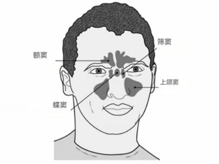 为什么说得了鼻窦炎的人要多哼歌？