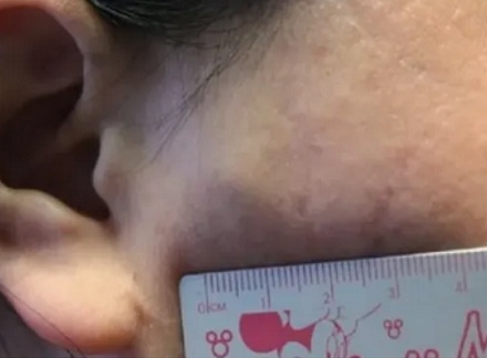 扎进皮肤里的各种刺，不管它们会怎么样？