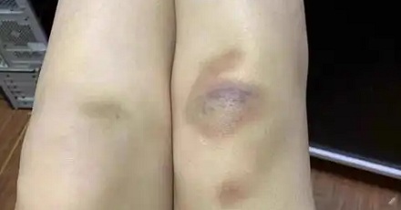 身上的淤青变成黄色，是快痊愈了还是更严重了？