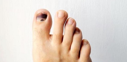 为什么有些马拉松运动员要拔掉自己的脚指甲？