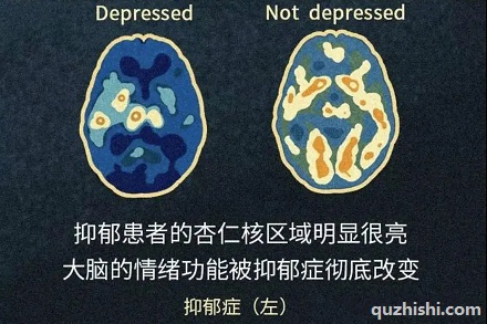 为啥抑郁症患者会有更多的「负面情绪」?